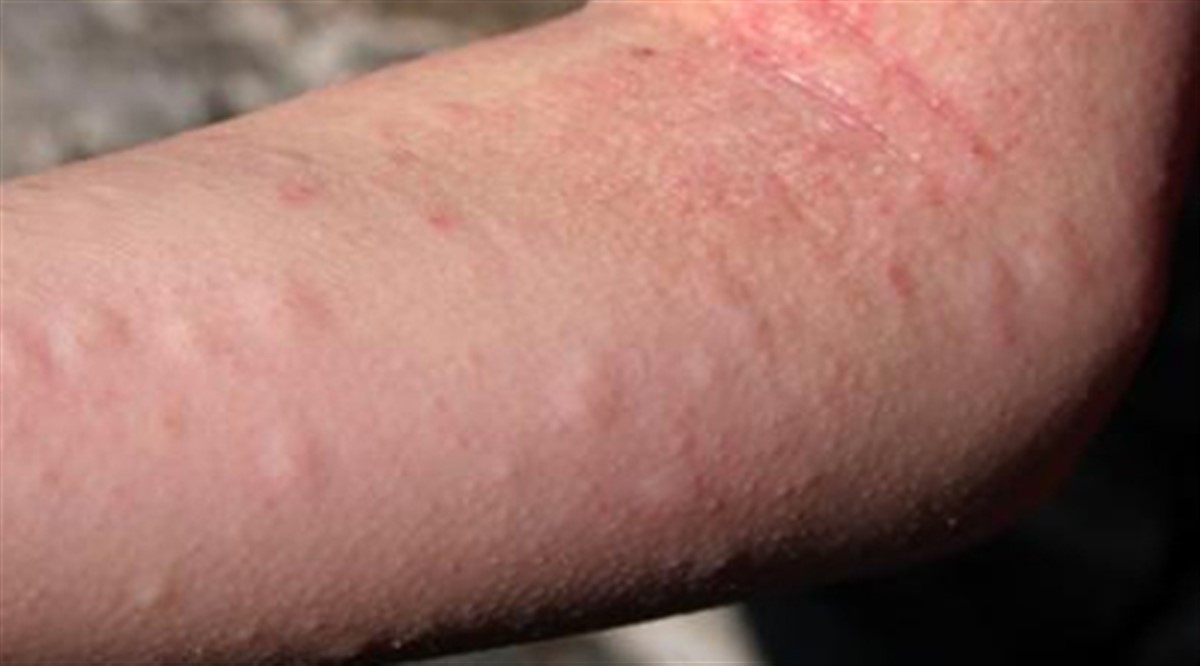 تشخیص و درمان حساسیت غذایی