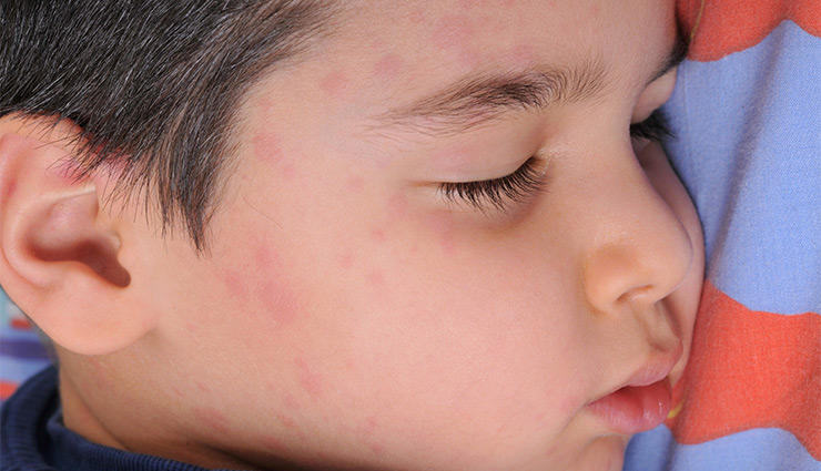 کهیر در کودکان و درمان آن