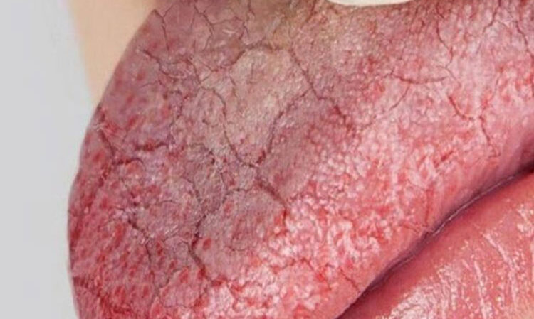 بیماری سندروم شوگرن جیست؟