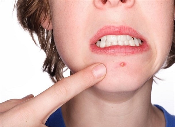 کورک و درمان آن