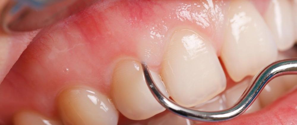 لکوپلاکی چیست؟