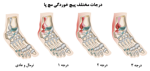 از علت تا درمان پیچ خوردن مچ پا