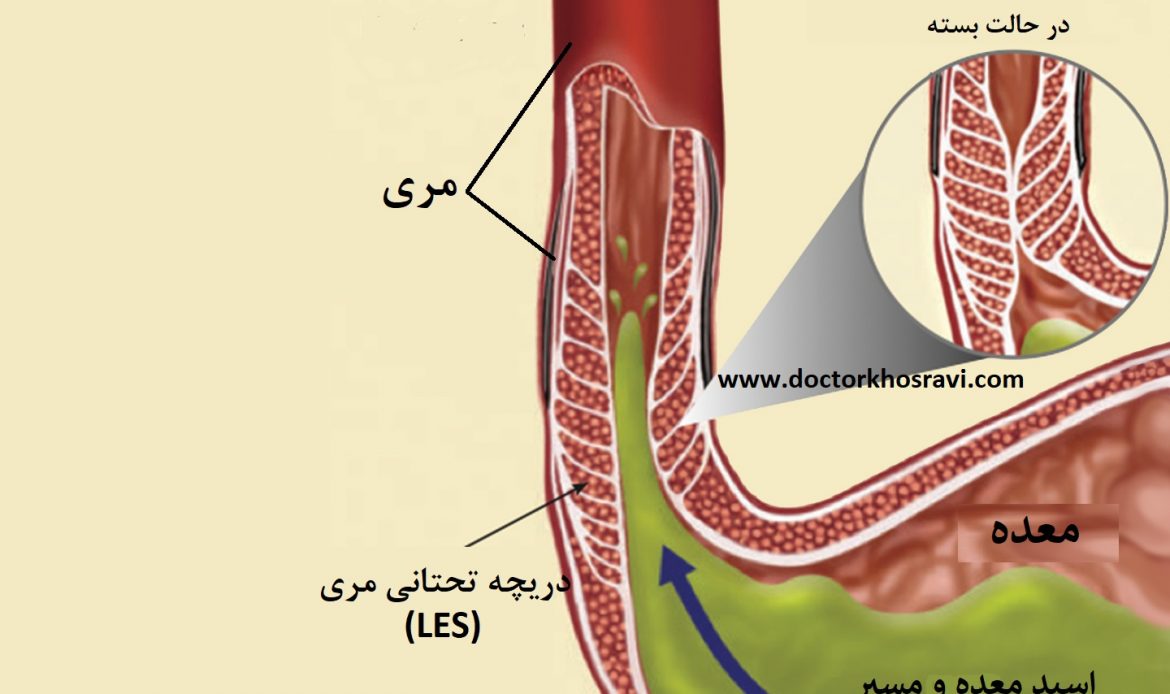 همه چیز درباره رفلاکس معده و مری
