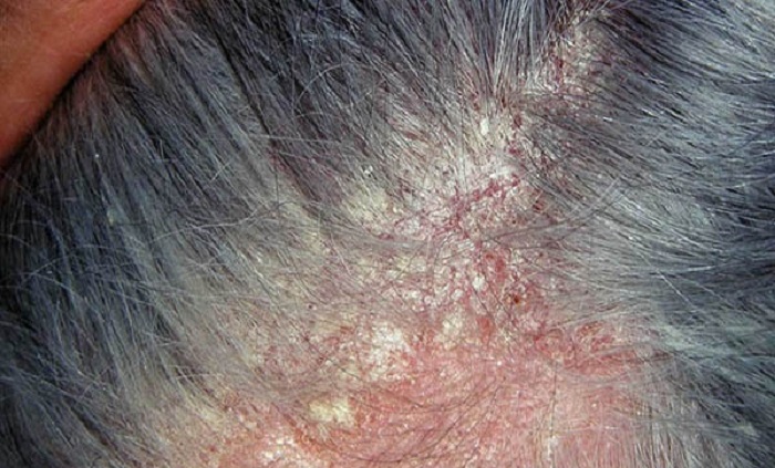 از علت تا درمان درماتیت سبوره ای