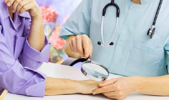 آیا خال مودار نشانه ای از سرطان است؟