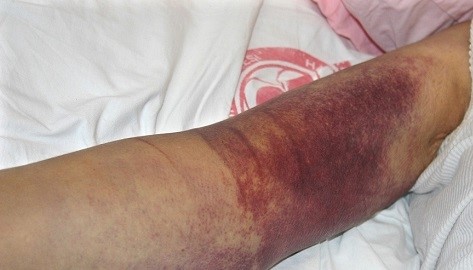 تب کنگو چیست؟ و چه علائمی دارد؟