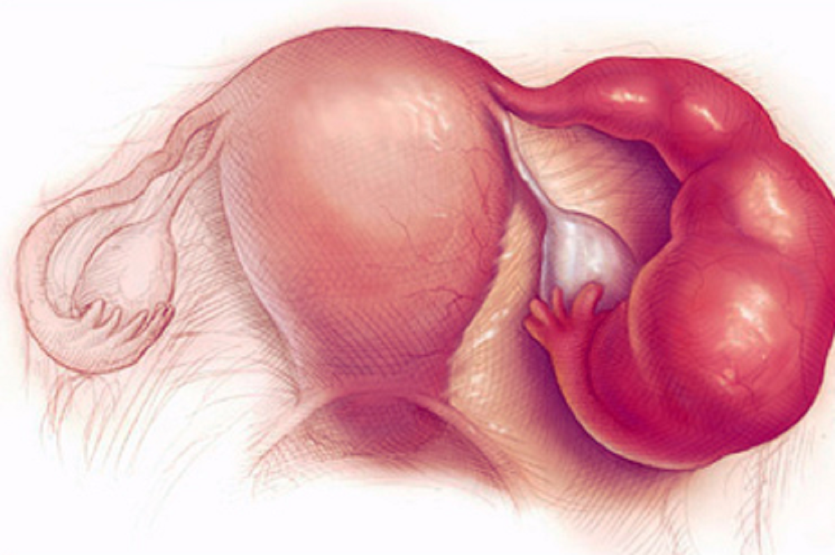علائم بیماری التهاب لگن در زنان و روش های درمان آن