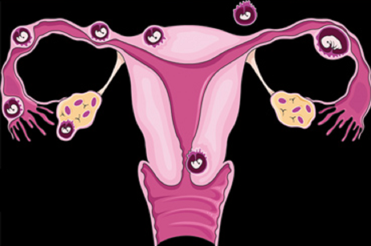 علائم بیماری التهاب لگن در زنان و روش های درمان آن