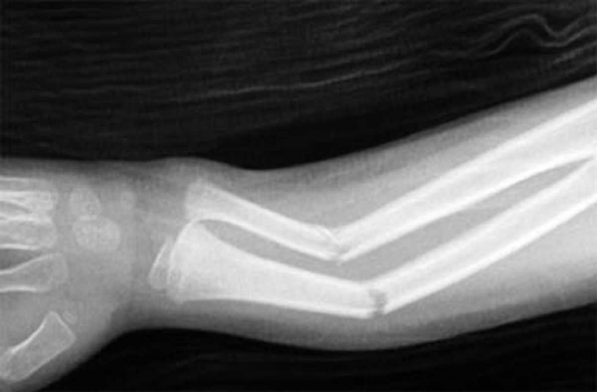 هر آنچه باید درباره بیماری پوکی استخوان ، علائم و درمان آن بدانیم