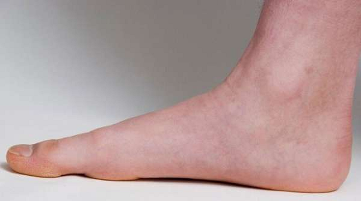 علائم و درمان صافی کف پا از کودکی تا بزرگسالی