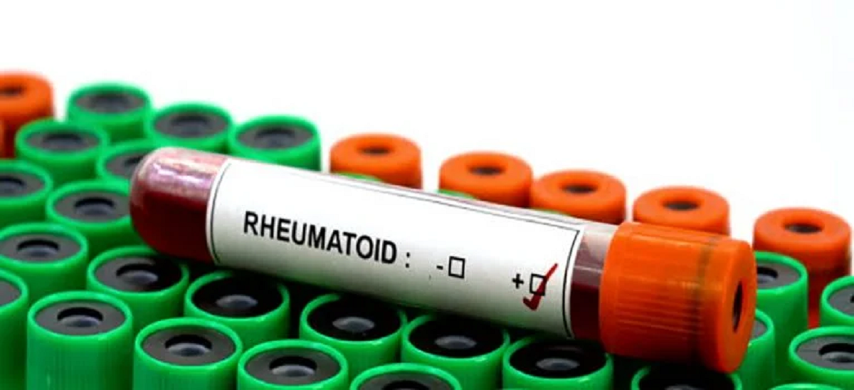 آزمایش‌هایی که برای تشخیص آرتریت روماتوئید یا روماتیسم مفصلی می توان انجام داد