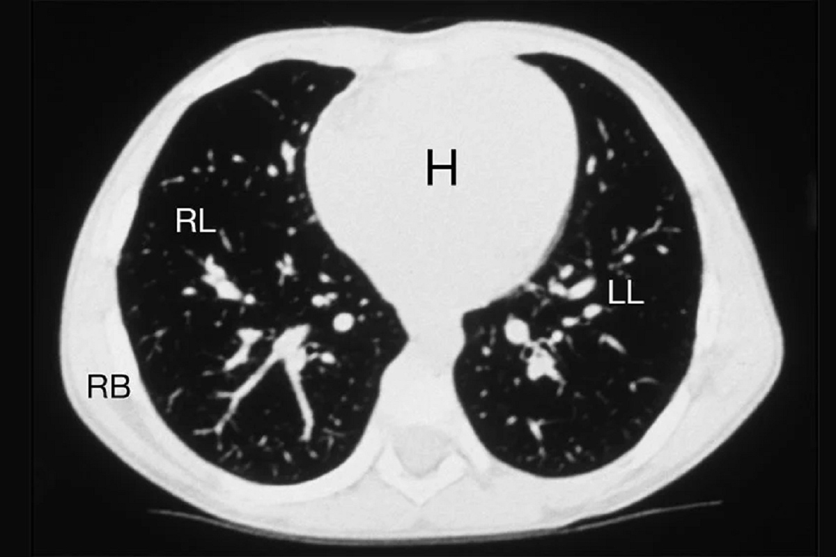 تشخیص زود هنگام سرطان با انجام تست غربالگری سرطان