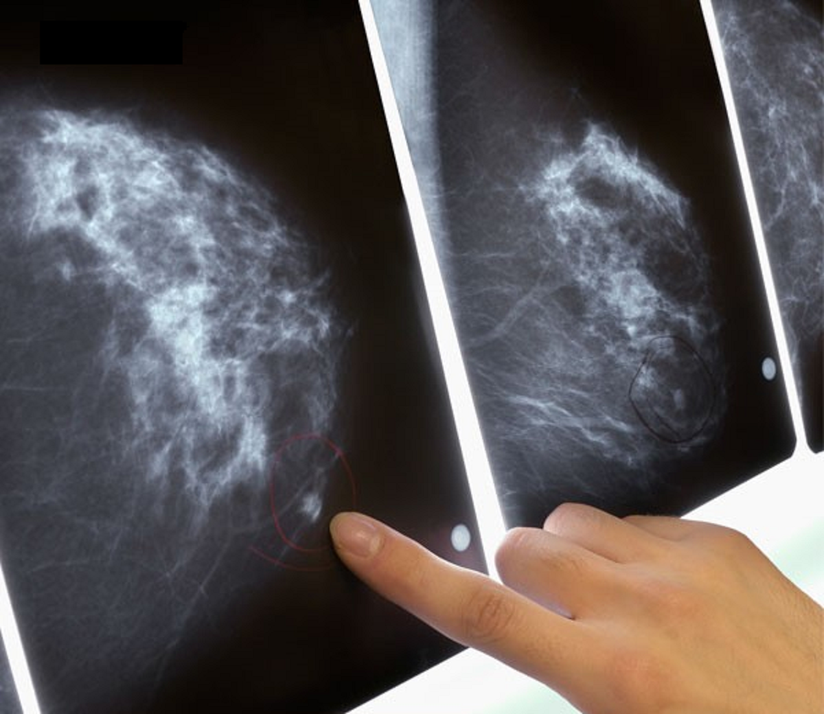 علائم سرطان سینه و راههای تشخیص و درمان آن