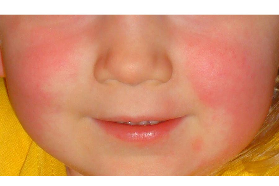 در مورد بیماری مخملک چه میدانید؟