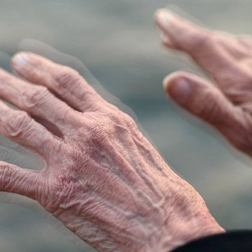 آیا پارکینسون بیماری روزگار پیری است؟