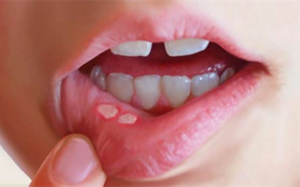 همه چیز درباره بیماری بهجت