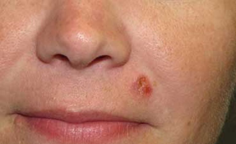 کارسینوم سلول بازال: علل،علائم و راه های درمان