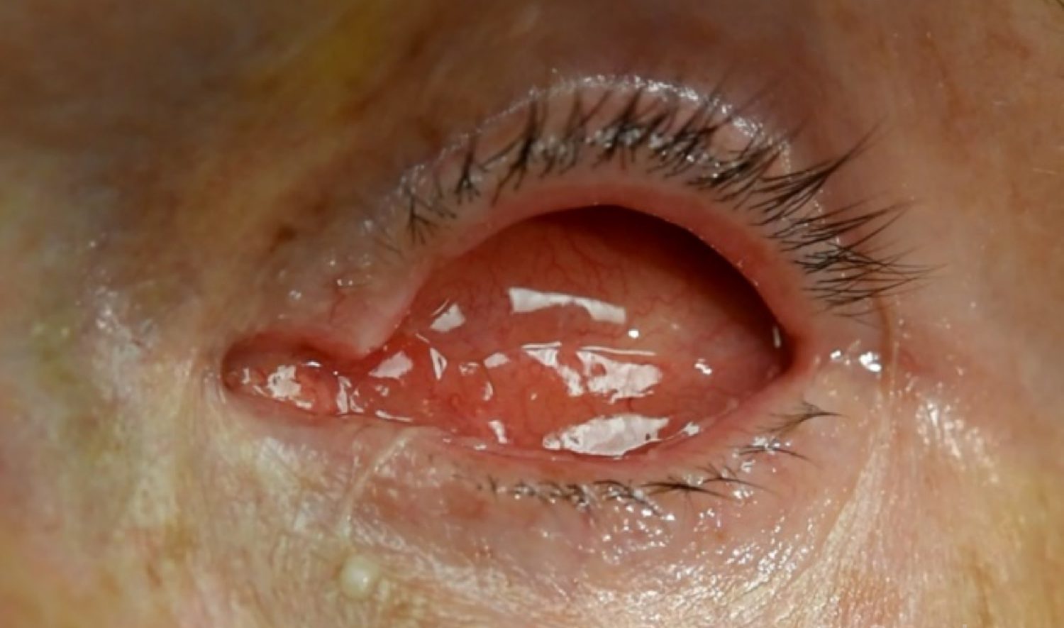 از علت تا درمان سرطان پلک