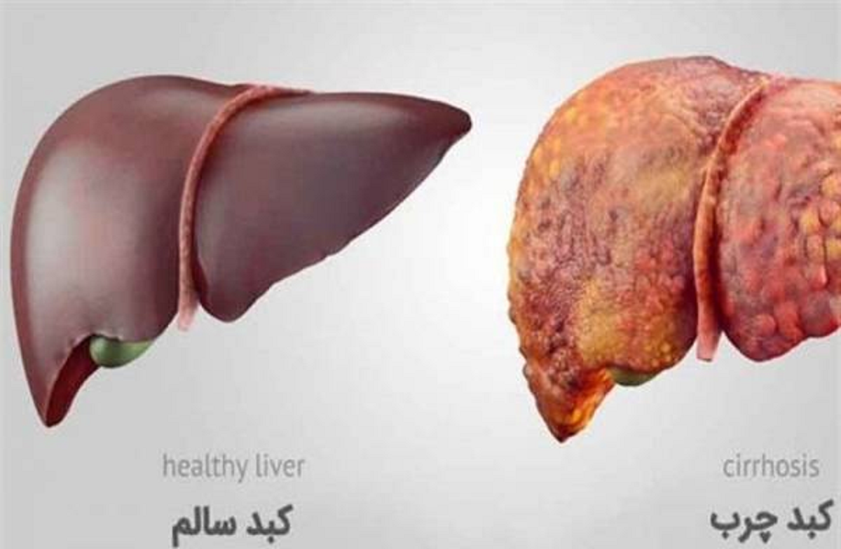 دانستنی هایی درباره بیماری کبد چرب و علائم و روش های تشخیص و درمان آن