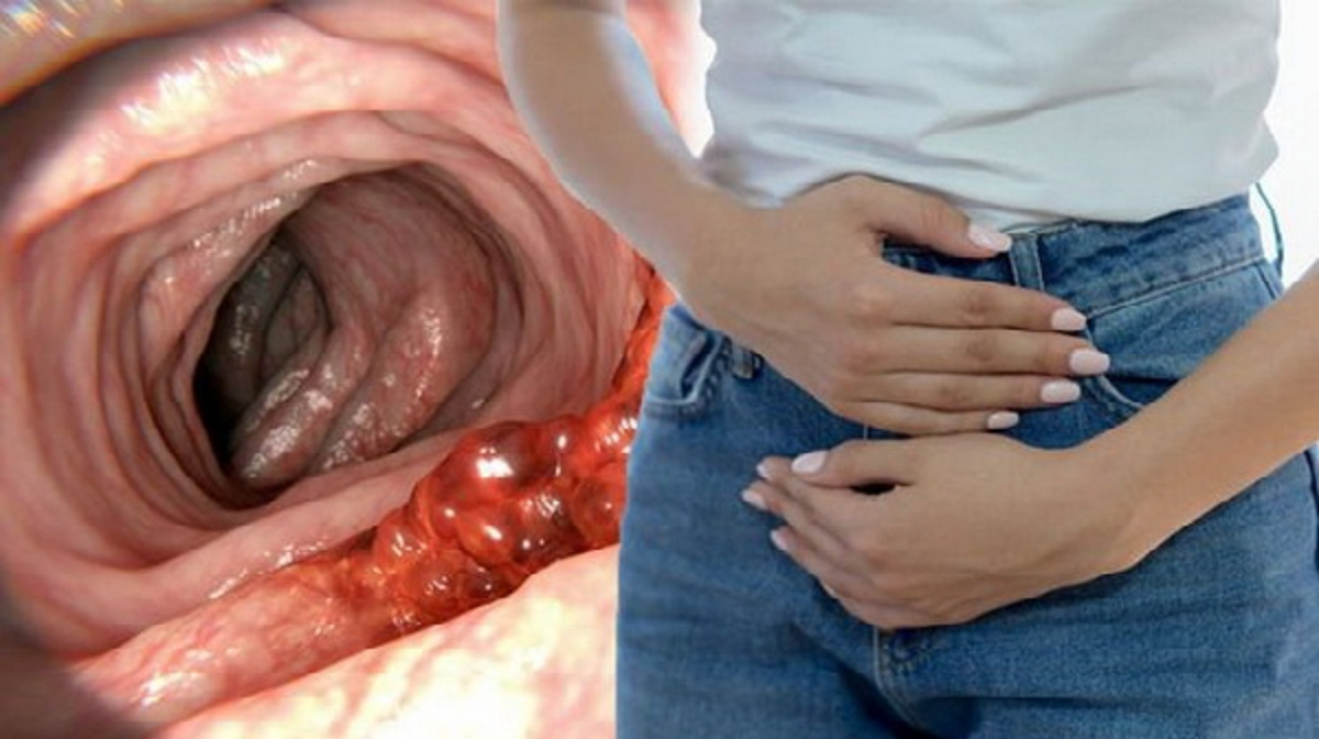 سرطان روده کوچک و بزرگ چه علائمی دارد و و راه‌های تشخیص آن چیست
