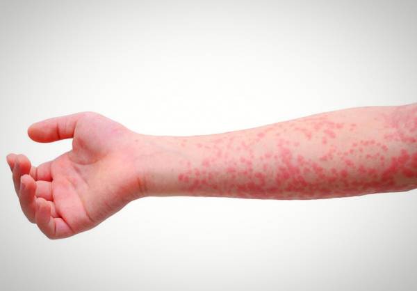 در مورد بیماری مخملک چه میدانید؟