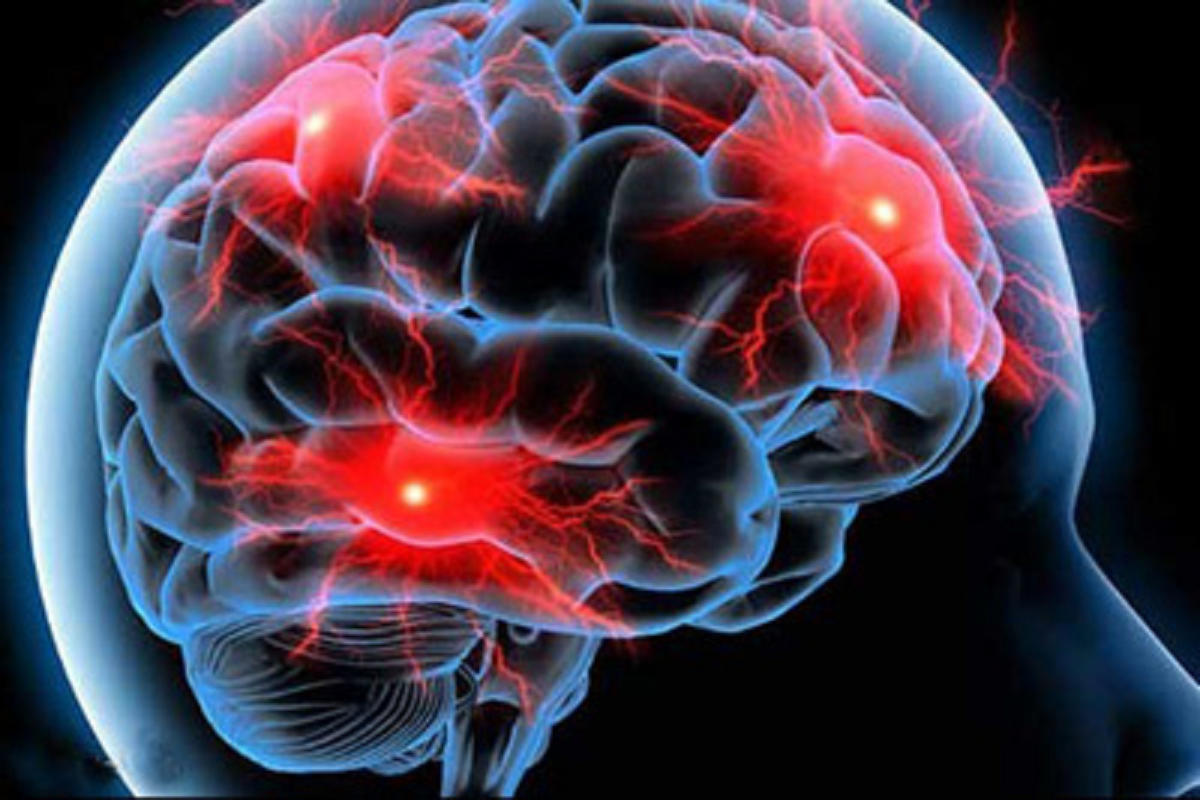 هرآنچه باید در مورد خونریزی مغزی بدانید از علل و علائم تا درمان آن