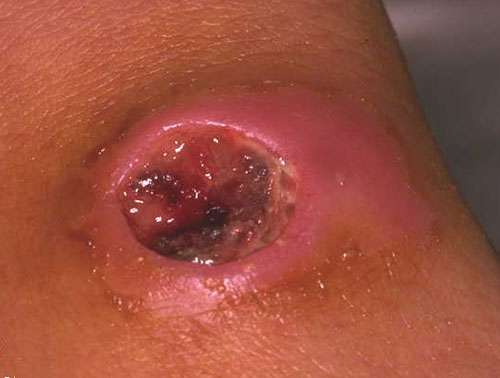 از بیماری سیاه زخم چه میدانید؟