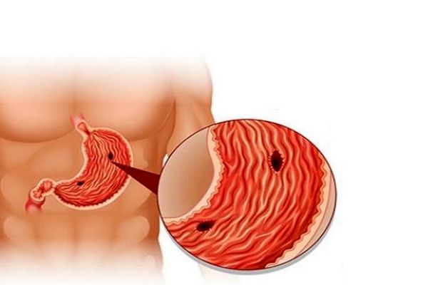 زخم پپتیک چیست؟