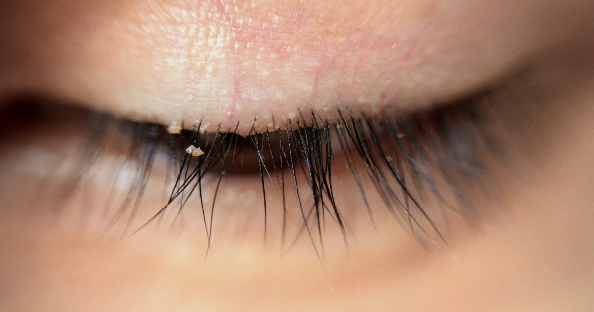 همه جیز راجع به بلفاریت چشم