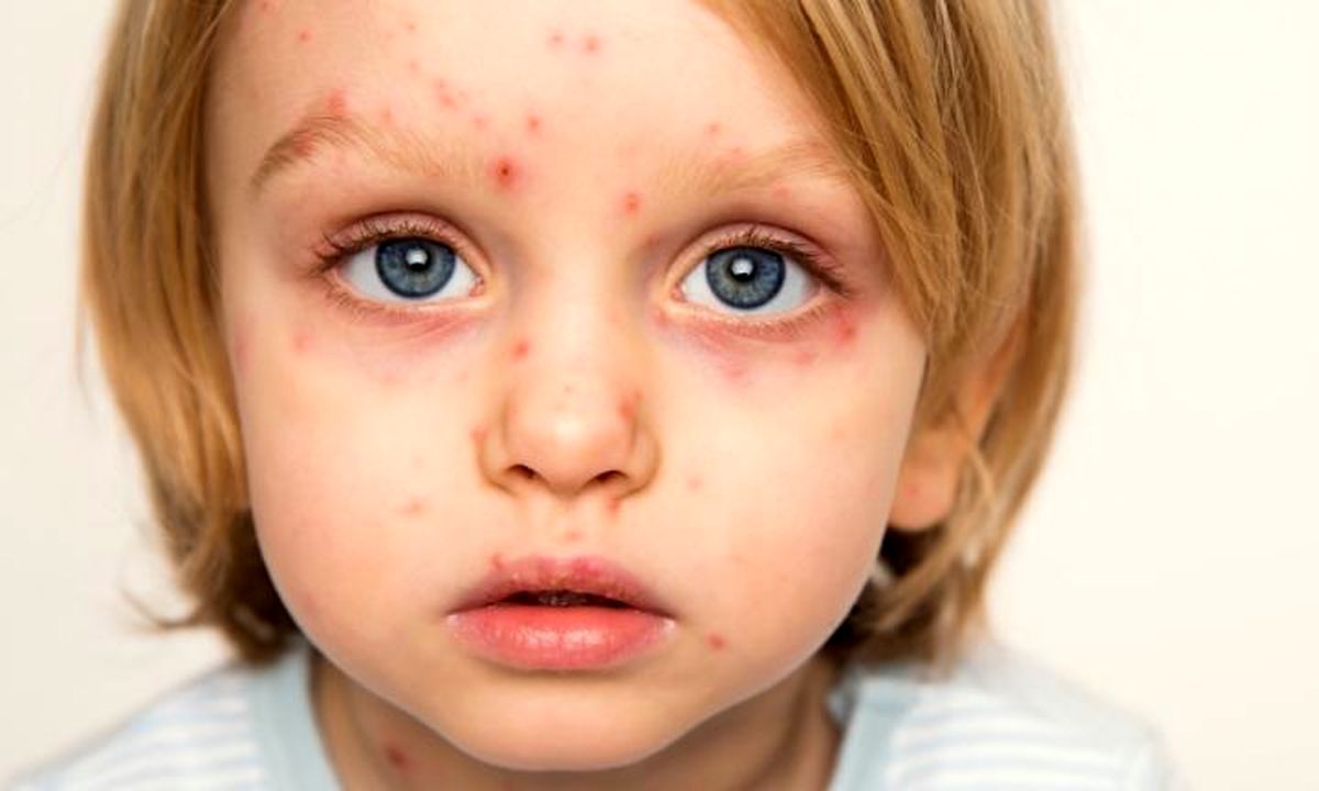همه چیز راجع به بیماری‌های نقص ایمنی در کودکان