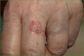 از کارسینوم یا سرطان سلول سنگفرشی چه میدانید؟