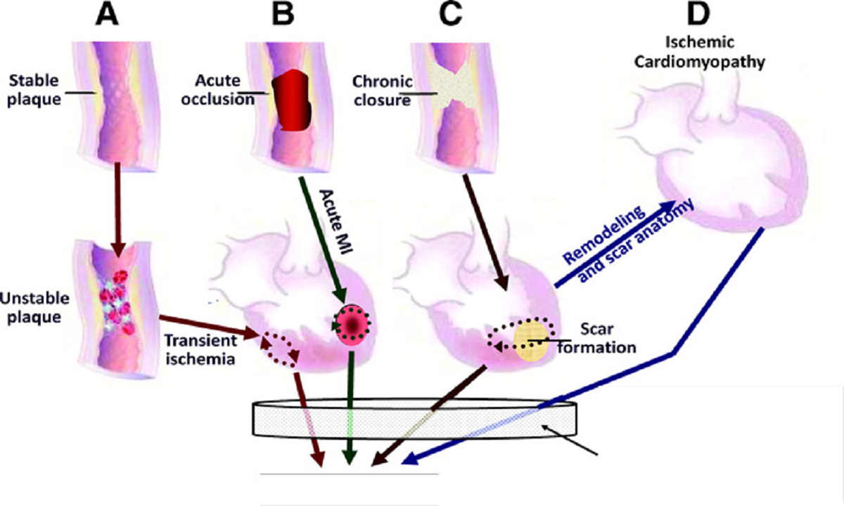 اسپاسم عروق کرونری قلب پیش از حمله قلبی و علائم، علل، تشخیص، درمان آن