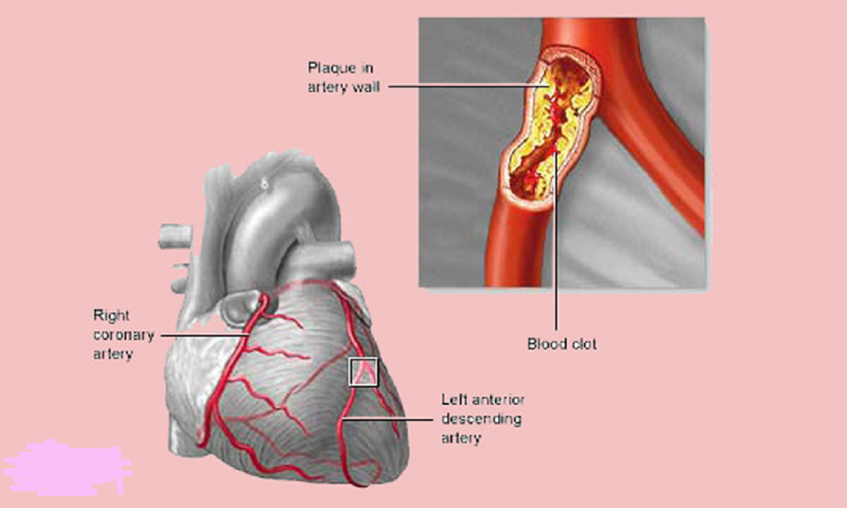 اسپاسم عروق کرونری قلب پیش از حمله قلبی و علائم، علل، تشخیص، درمان آن