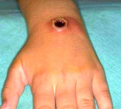 از بیماری سیاه زخم چه میدانید؟