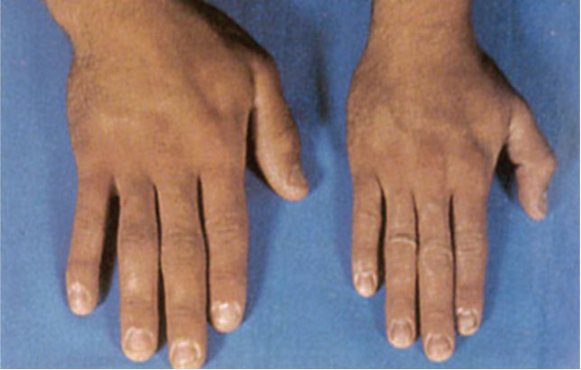 آکرومگالی و راه های درمان