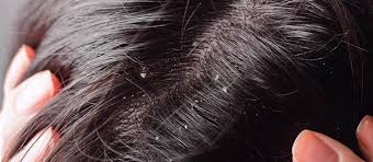 راه های کاهش شوره سر