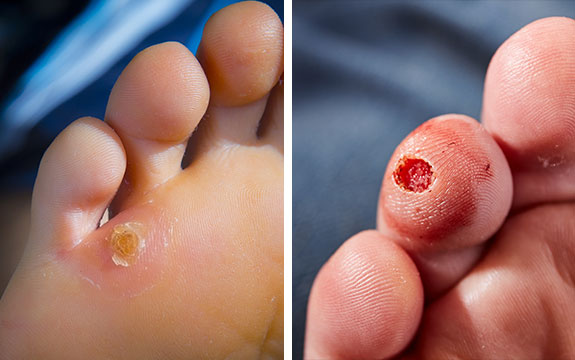 تفاوت زگیل و میخچه در چیست؟