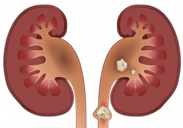 هیپرکلسمی چیست و چگونه درمان میشود؟