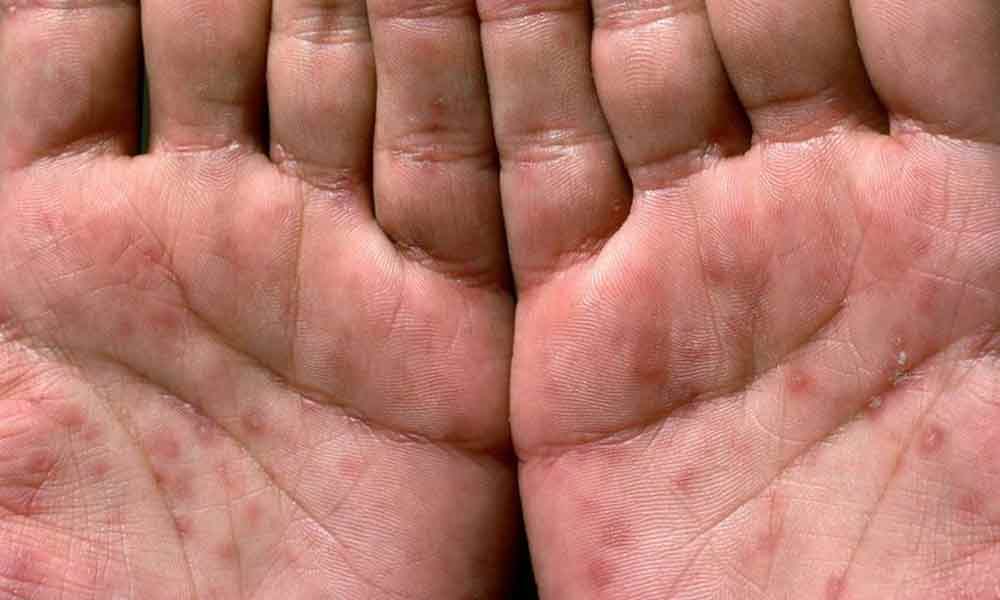 بیماری سفلیس