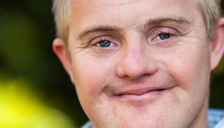 انواع سندروم داون، علت، علائم، تشخیص و درمان آن