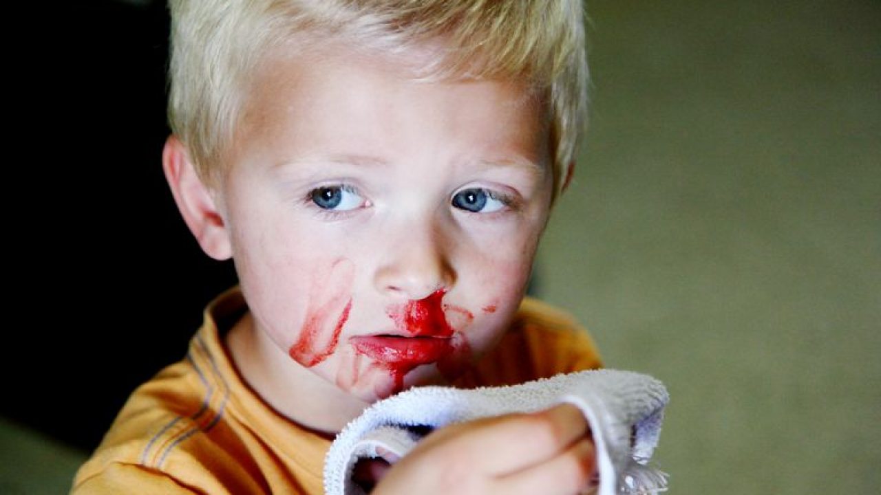 خونریزی بینی در کودکان