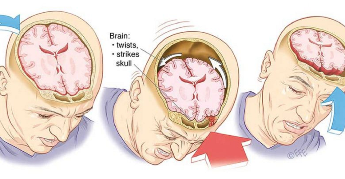 علائم، علل و عوارض ضربه ی مغزی