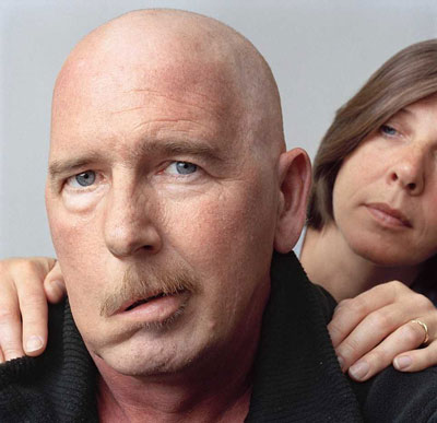 فلج صورت را با سکته مغزی اشتباه نگیرید