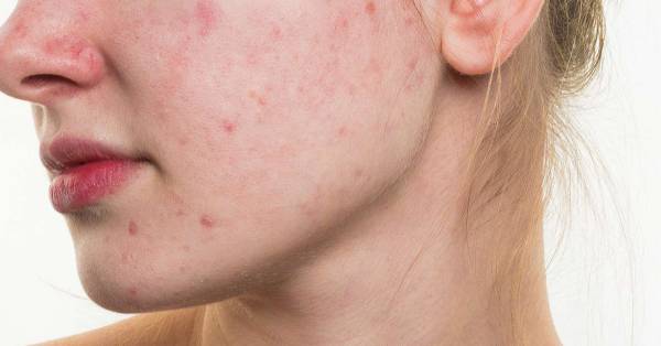 همه چیز درباره بیماری رزاشیا یا رزاسه