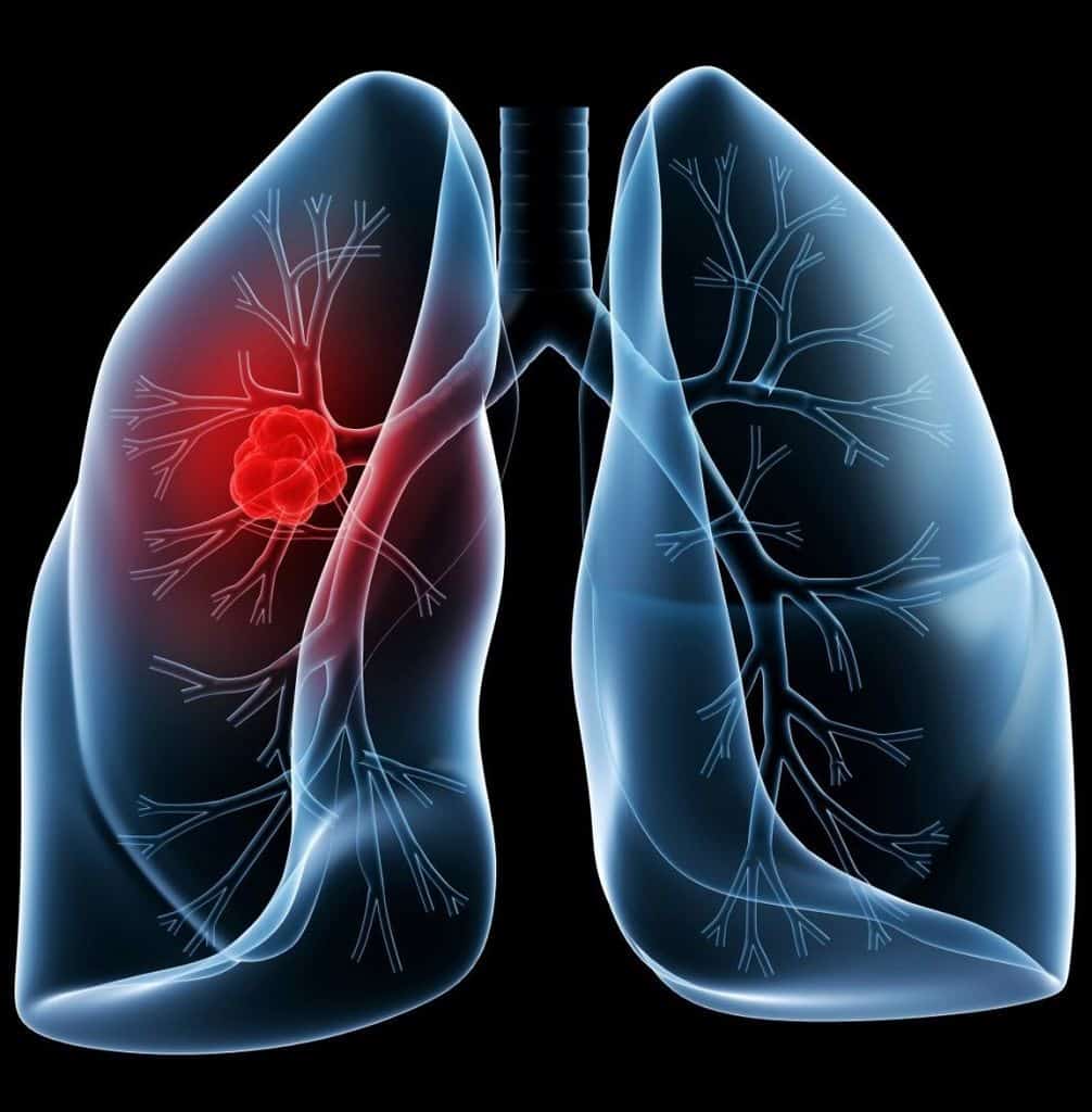 بیماری برونشیت