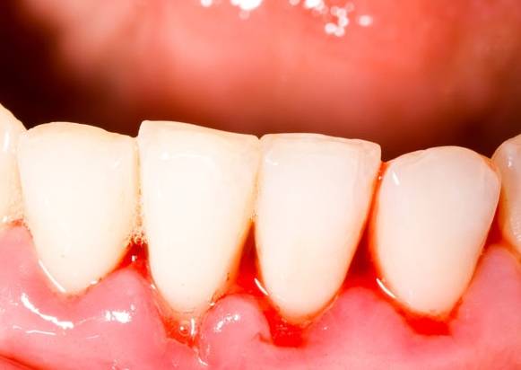 جوش لثه را در خانه درمان کنید