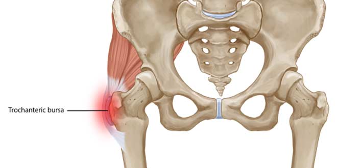آشنایی با بیماری بورسیت