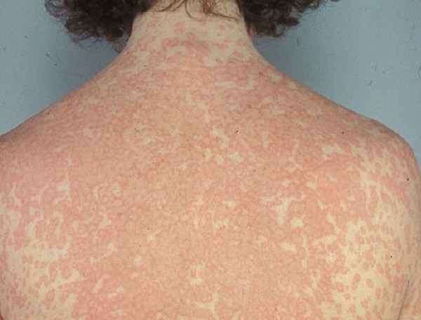 آشنایی با علائم و نشانه های حساسیت به پنی سیلین