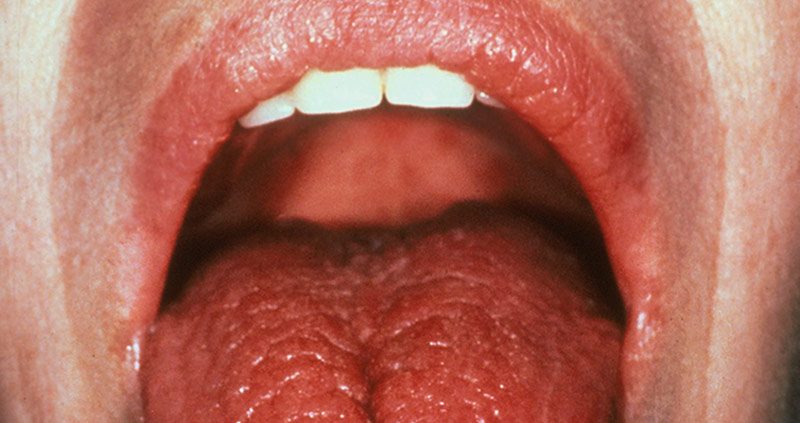 بیماری سندروم شوگرن جیست؟