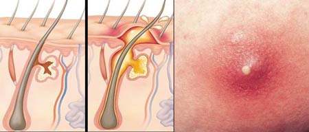 کورک و درمان آن